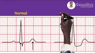 ECG changes of Unstable Angina amp NSTEMI  TutorMed electrocardiogram nstemi unstableangina usmle [upl. by Jeramey]