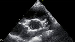 Bicuspid Aortic Valve BAV Pediatric echo study [upl. by Leizar]