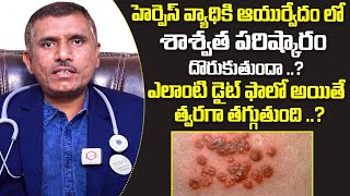 హెర్పెస్ వ్యాధికి శాశ్వత పరిష్కారం Dr Ramana Raju About Permanent Solution For Herpes Disease [upl. by Neeleuqcaj763]