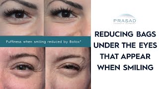 How Bags Under Eyes When Smiling can be Treated [upl. by Cocke]