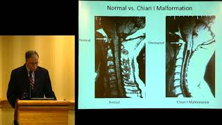 quotSyringomyelia Update Diagnosis Treatment and Researchquot  John D Heiss MD [upl. by Naharba397]