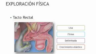 Hiperplasia Prostática Benigna  Parte 3wmv [upl. by Sidras]