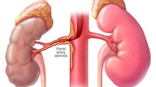 Renal artery stenosis  Renal artery stenosis procedure  stenting  renal artery stenosis treatment [upl. by Petulah]