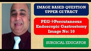 PERCUTANEOUS ENDOSCOPIC GASTROSTOMY UPPER GI TRACT Image Based Question [upl. by Lavro]