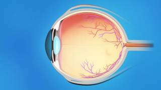 Understanding Glaucoma [upl. by Zetram]