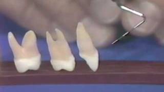 Case of the Week Immediate Extraction and Implant Placement [upl. by Akiehsal]