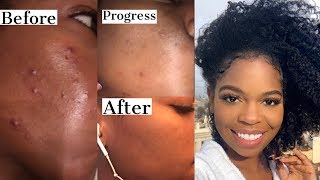 My Acne Prone Skincare Routine How I cleared up My AcneDiscoloration FT Ambi [upl. by Casilde336]