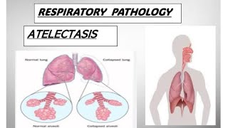 Respo pathology  ATELECTASIS and its types atelectasis copd pathology [upl. by Yllod140]