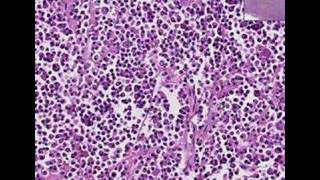 Histopathology NoseExtramedullary plasmacytoma [upl. by Nreval]