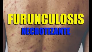 FURUNCULOSIS Dermatología Pústulas NECRÓTICAS folículo piloso infectado  Dr Arenas [upl. by Ahsiliw982]