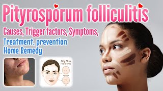 Pityrosporum folliculitis definition causes symptoms diagnosis treatment preventionhome remedy [upl. by Aicnorev]