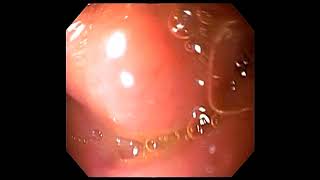 Normal oesophagogastroscopyDuodenitis withduodenal ulcer [upl. by Lantz]