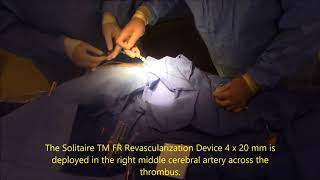 Mechanical thrombectomy for acute ischemic stroke [upl. by Acassej]