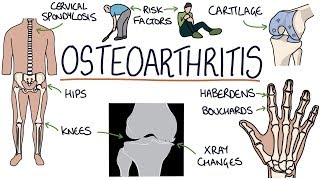 Understanding Osteoarthritis [upl. by Lala717]