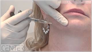 NonSurgical Jowl and Jawline Lift  Dr Babak Azizzadeh in Beverly Hills [upl. by Letsyrk]