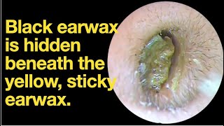 Black earwax is hidden beneath the yellow sticky earwaxear wax removal  ear cleaning  ASMR [upl. by Notnyw]