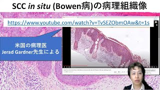 SCC in situ Bowen病）病理組織解説動画 [upl. by Rehpotsyrhc]