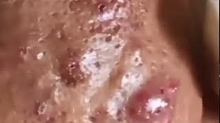 Popping blackheads 2024 [upl. by Neeruan866]