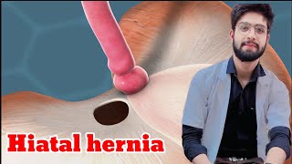 Hiatus hernia anatomy more [upl. by Timofei]