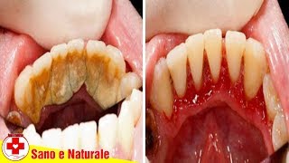 5 Modi Naturali per Rimuovere lAccumulo di Tartaro Dai Denti [upl. by Naus562]