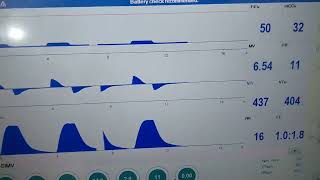 How to measure end tidal CO2 of a patient in ventilator end tidal carbon dioxide levels measurement [upl. by Schonthal909]