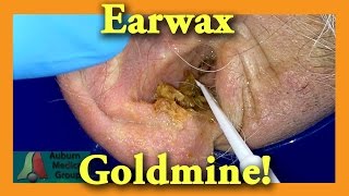 Earwax GOLDMINE  Auburn Medical Group [upl. by Genevieve]