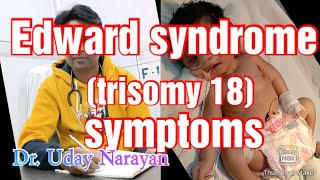 Edward syndrome trisomy 18😊 [upl. by Neelhtac48]