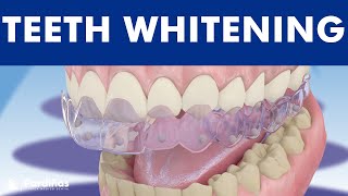 Teeth whitening  How is it done © [upl. by Glass807]