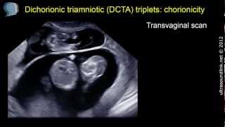 Chorionicity determination lambda sign on 3D scan [upl. by Ermey]