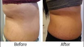 VelaShape cellulite treatment before and after [upl. by Eisus315]