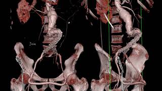 CT of Abdominal Aorta Aneurysms Dissections and Repair Part 2 [upl. by Luciano706]