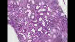 Histopathology KidneyRapidly progressive glomerulonephriti [upl. by Worth739]