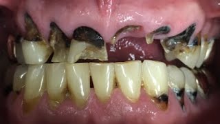 Meth Mouth  A Dentists Worst Nightmare Can It Be Treated [upl. by Noraha684]