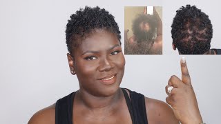 How to regrow your hair with CCCA or scarring alopecia [upl. by Brannon641]