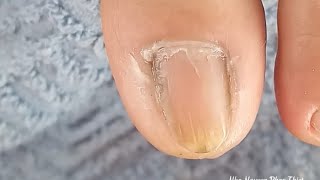 The toes have the most dead skin at the corners of the toenails  part 112NhaNguyenPhanThiet [upl. by Eivad]