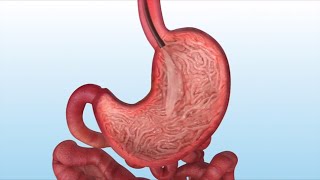 How is the Gastric Balloon Inserted and Removed [upl. by Nytsua]