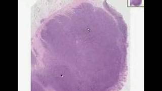 Histopathology ColonBurkitt lymphoma [upl. by Odraboel]