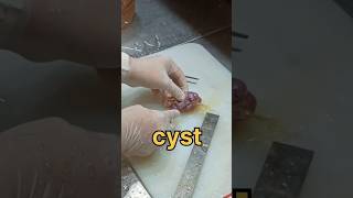 Cyst from the fallopian tube [upl. by Adnwahsar122]