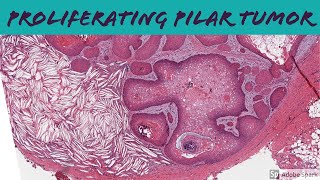 Proliferating Pilar Tumor 5Minute Pathology Pearls [upl. by Marlee]