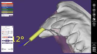 exocad Quick Guide Angulated Screw Channel [upl. by Aropizt]