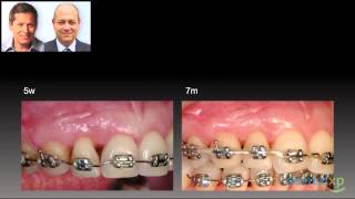 Sequencing of Periodontal Procedures and Orthodontic TreatmentjCD 2094 [upl. by Lopes]