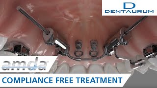 amda®  compliancefree treatment advanced molar distalization appliance [upl. by Hiller]