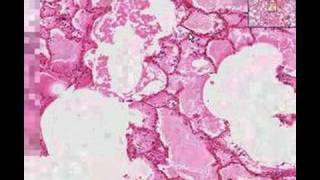 Histopathology Lung Acute pulmonary edema Asbestos bodies [upl. by Gentilis780]