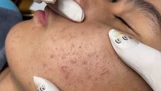 ACNE TREATMENT VU QUYNH MI Acne On Teens Cheek 2024 [upl. by Adallard]