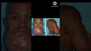 Ameloblastoma Facial Jaw Growth  Odontogenic Tumor Benign Tumor [upl. by Dnaltiak202]