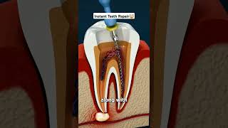 Damaged Tooth Repair Entire Process shorts viral [upl. by Afinom316]