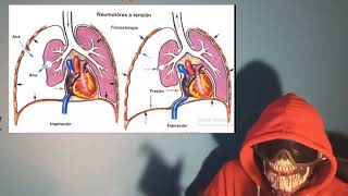 Explicación y APH de Neumotórax a Tensión abierto simple y Hemotórax [upl. by Jariv]