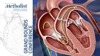 Management of Group 2 Pulmonary Hypertension Hope or Hype Raymond L Benza MD February 17 2022 [upl. by Kilan]