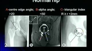 Femoroacetabular Impingement [upl. by Mab818]