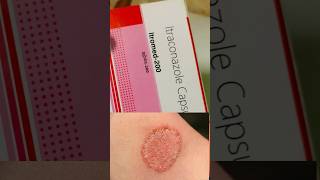 Itraconazole capsule  Itraconazole 100mg  shorts shortvideo ytshorts skincare fungalinfection [upl. by Cloe331]